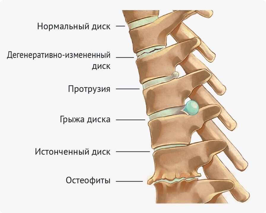 Дискови деформации за лумбална остеохондроза