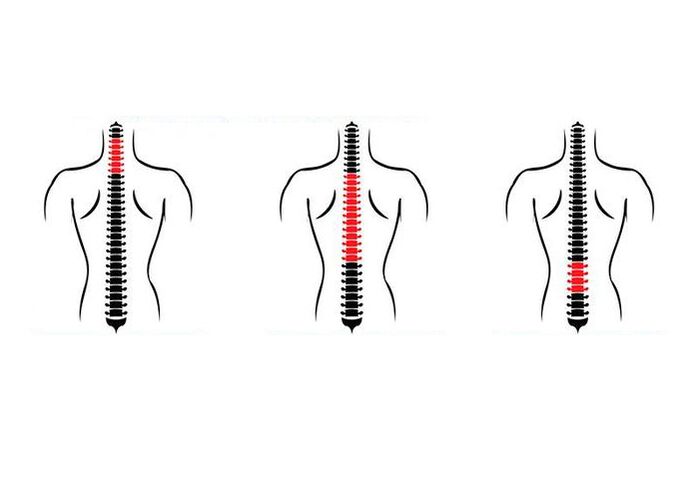 Как се проявява остеохондрозата
