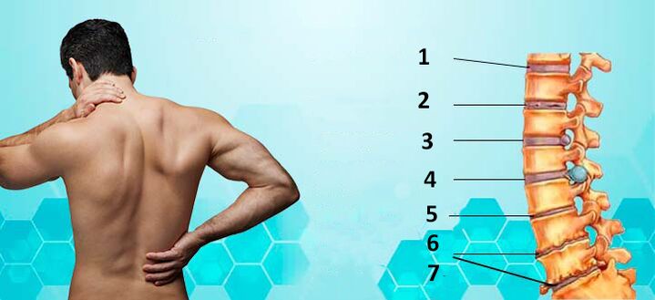 етапи на развитие на остеохондроза