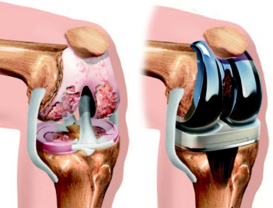 В случай на пълно увреждане на колянната става от артроза, тя може да бъде възстановена чрез ендопротезиране