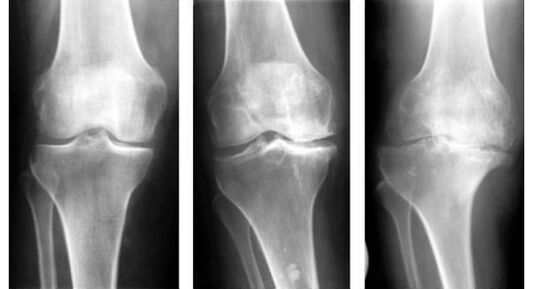 Задължителна диагностична мярка при идентифициране на артроза на коляното е рентгеново изследване