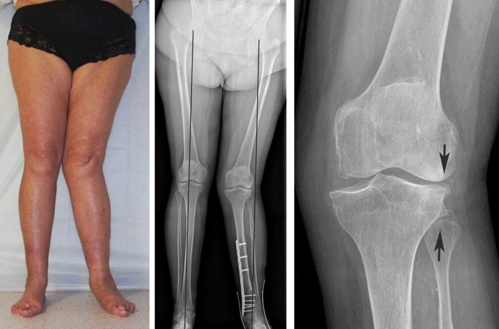 Разширената артроза на коленните стави е ясно видима визуално дори без рентгенови лъчи